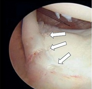 Figure from article: SHOULDER INTERNAL...